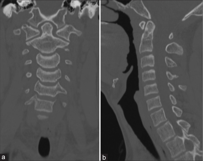 Single dose intralesional doxycycline foam infusion promotes bone growth and resolution of an odontoid aneurysmal bone cyst.