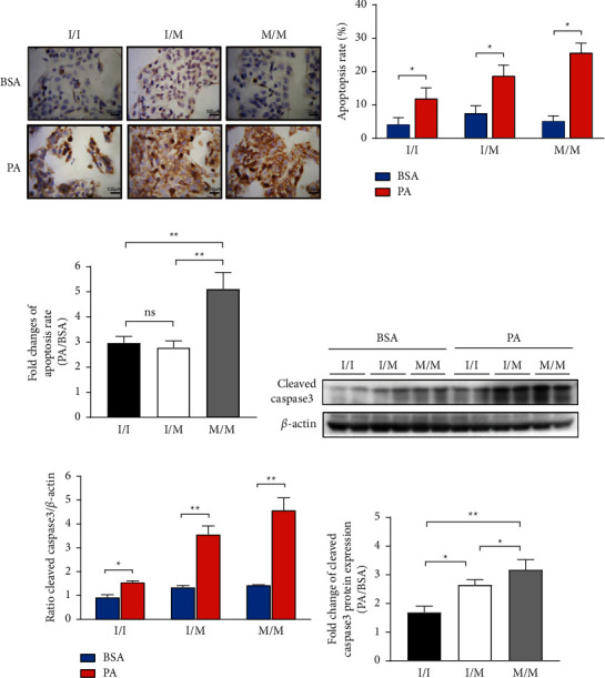 PNPLA3 148M/M Is More Susceptible to Palmitic Acid-Induced Endoplasmic Reticulum Stress-Associated Apoptosis in HepG2 Cells.