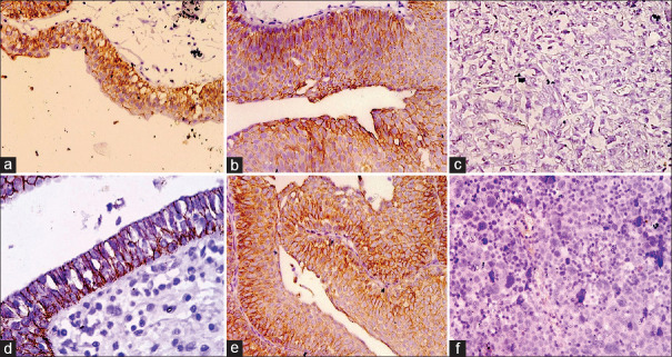 The study of miRNA-200c expression and epithelial-to-mesenchymal transition-related transcription factors in the primary bladder urothelial carcinoma.