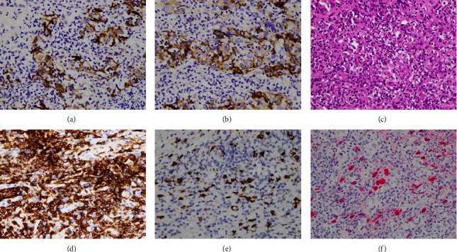 Lymphocyte-Rich Hepatocellular Carcinoma with Multiple Lymphadenopathy and Positive Epstein-Barr Virus Encoding Region.