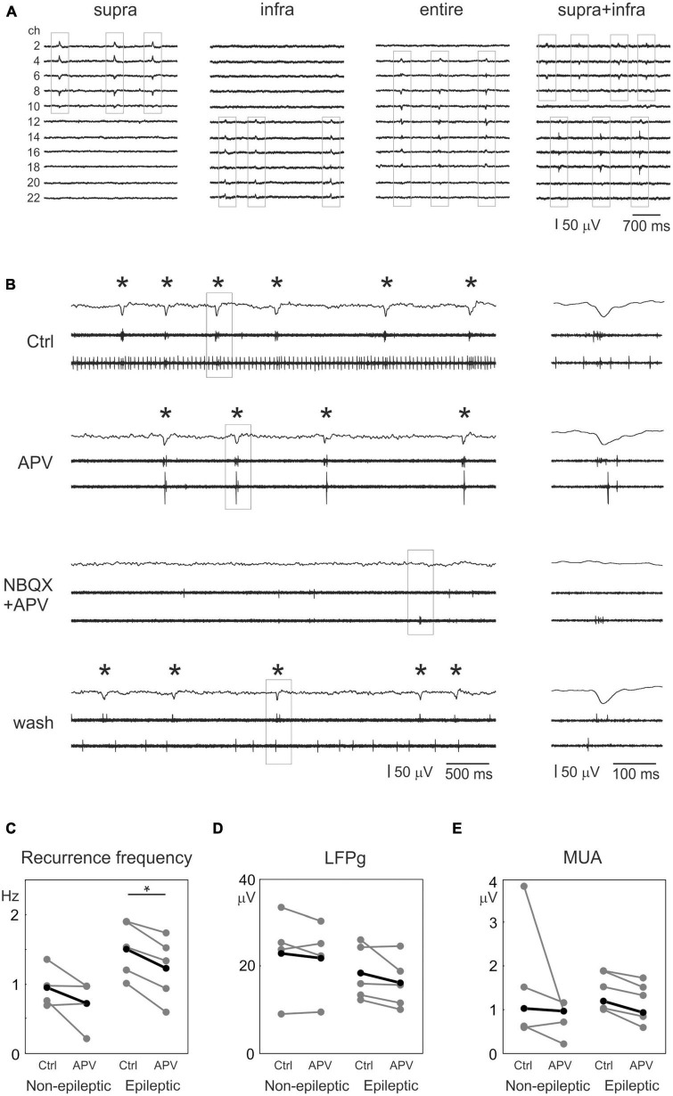 Synaptic alterations and neuronal firing in human epileptic neocortical excitatory networks.