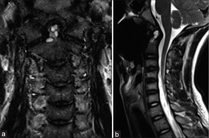 Single dose intralesional doxycycline foam infusion promotes bone growth and resolution of an odontoid aneurysmal bone cyst.