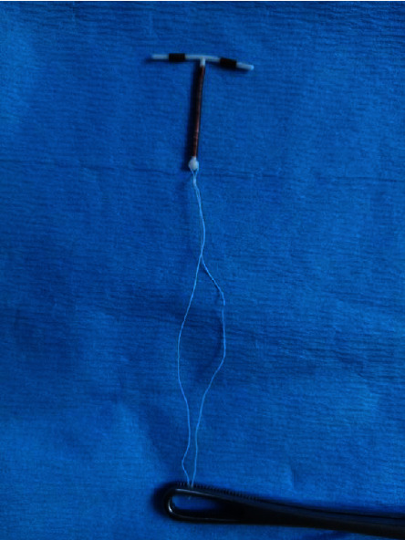 Novel Concepts for Intrauterine Device Placement at Caesarean Delivery: Description of Technique and Video Recording.