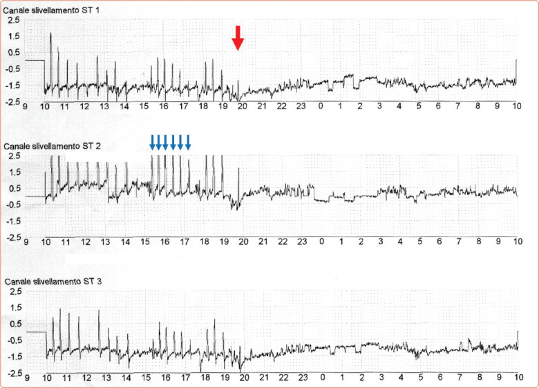 Management of Coronary Artery Spasm.