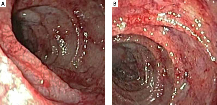 Type B aortic dissection atypically presenting as chronic abdominal pain.