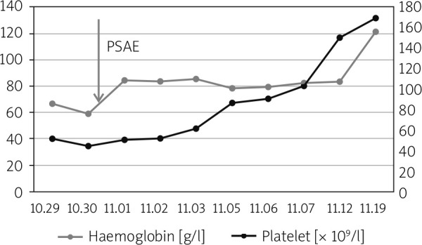 Splenic artery embolization for the treatment of pancreatic portal hypertension complicated by gastric variceal haemorrhage.