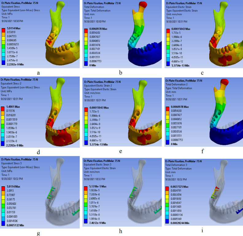 Three Different Fixation Modalities following Mandibular Setback Surgery with Sagittal Split Ramus Osteotomy: A Comparative Study using Three-dimensional Finite Elements Analysis.