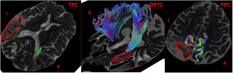 Corticocerebellar White Matter Integrity Is Related to Naming Outcome in Post-Stroke Aphasia.