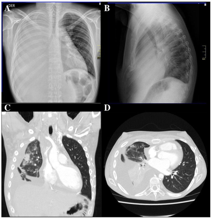 Massive Right Chylothorax Secondary to a Severe Systemic Lupus Erythematosus Flare With Secondary Evans Syndrome: A Case Report and Literature Review.