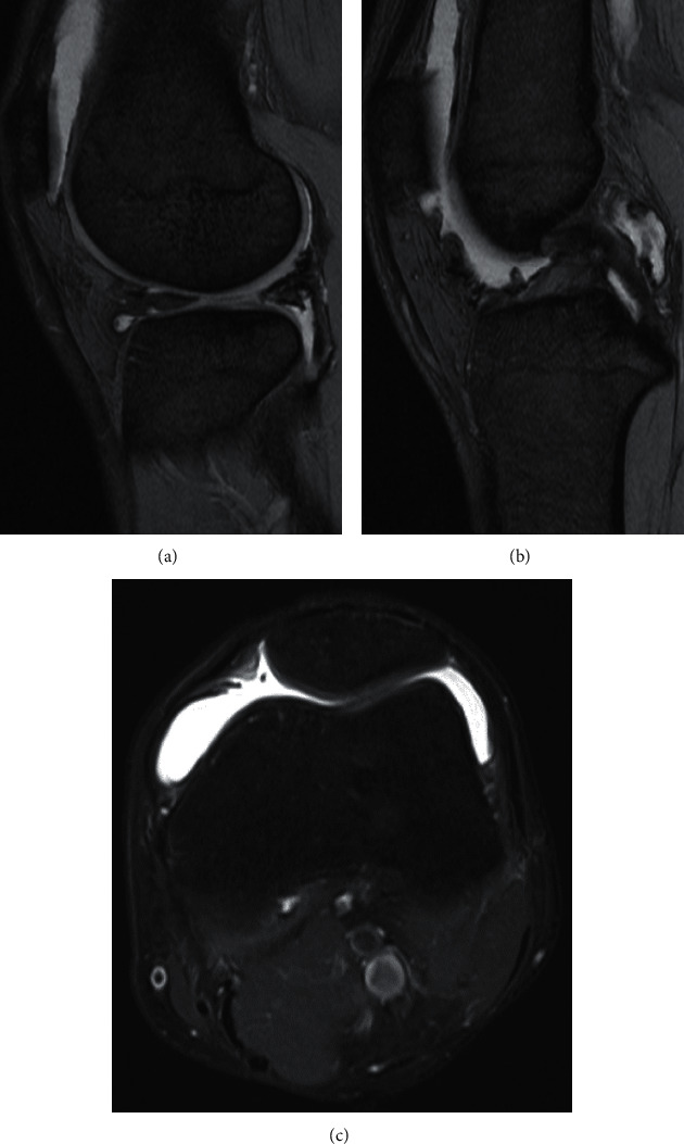 Persistent Hemarthrosis of the Knee after Arthroscopic Meniscal Repair.