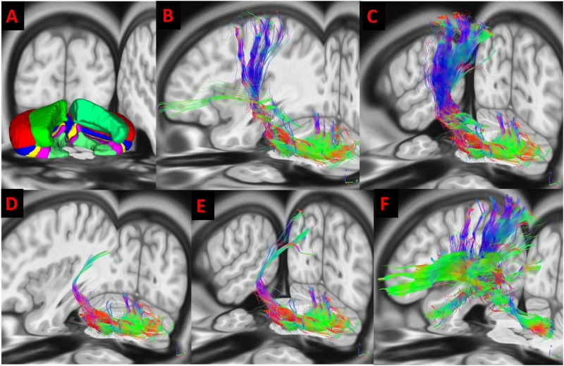 Corticocerebellar White Matter Integrity Is Related to Naming Outcome in Post-Stroke Aphasia.