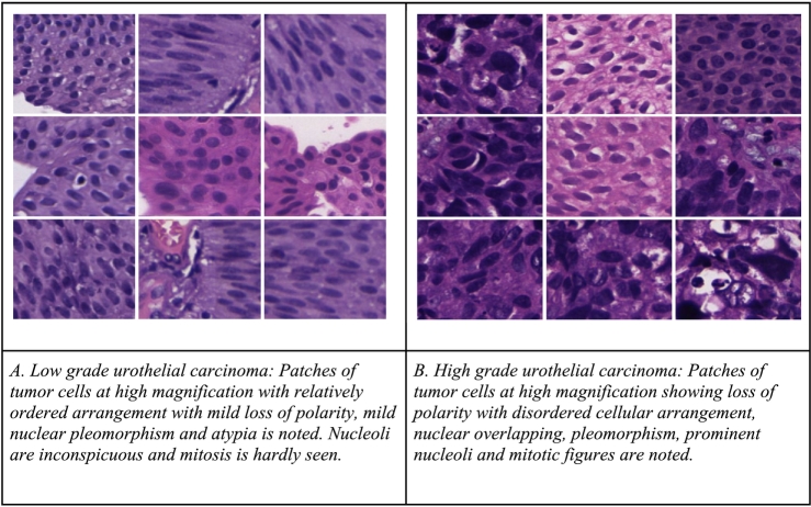 Differentiation of urothelial carcinoma in histopathology images using deep learning and visualization