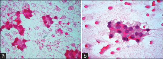 Cytological Features of "Non-Invasive Follicular Tumour with Papillary like Nuclear Features" - A Single Institutional Experience in India.