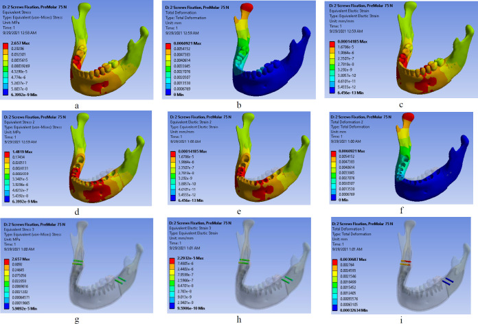 Three Different Fixation Modalities following Mandibular Setback Surgery with Sagittal Split Ramus Osteotomy: A Comparative Study using Three-dimensional Finite Elements Analysis.