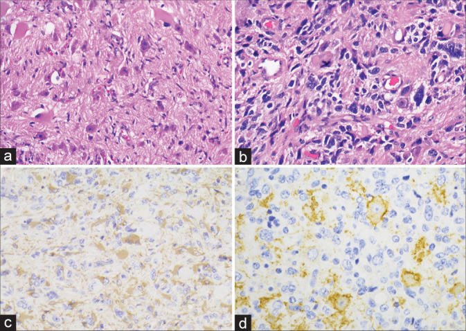 Primary spinal intramedullary anaplastic ganglioglioma in a pediatric patient.