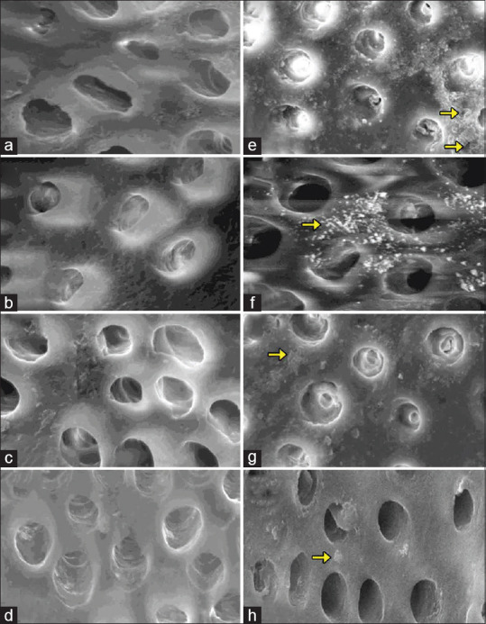 Evaluation of Dentin Remineralization with Zinc Oxide and Calcium Fluoride Nanoparticles - An <i>In vitro</i> Study.