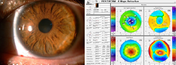 Central Toxic Keratopathy Following Corneal Collagen Cross-Linking.