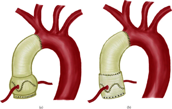 Valve-Sparing Aortic Root Replacement Technique: Valsalva Graft versus Two Straight Tubular Grafts.