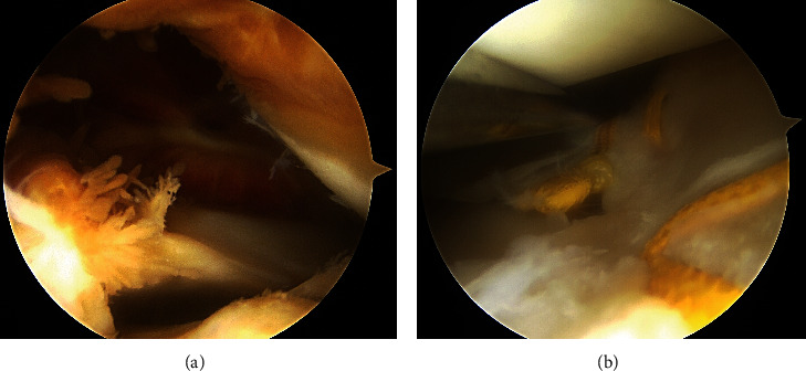 Persistent Hemarthrosis of the Knee after Arthroscopic Meniscal Repair.