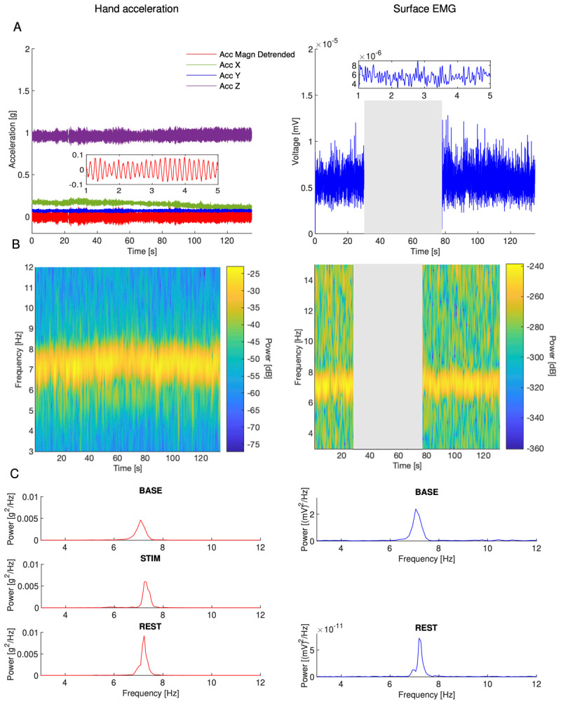 Brief Submotor-Threshold Electrical Stimulation Applied Synchronously Over Wrist Flexor and Extensor Muscles does Not Suppress Essential Tremor, Independent of Stimulation Frequency.