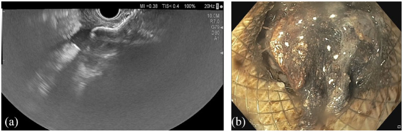 Endoscopic ultrasound drainage of pancreatic fluid collections: do we know enough about the best approach?