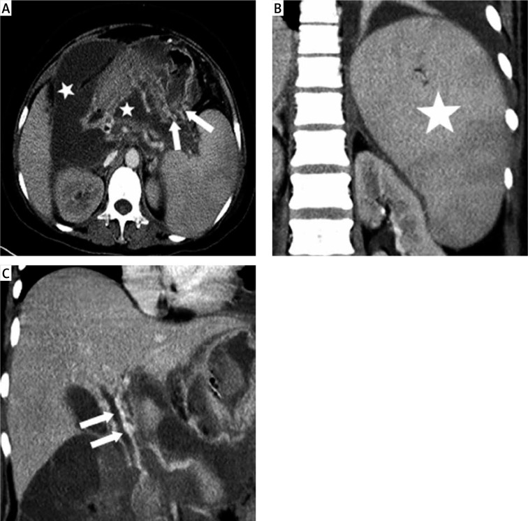 Splenic artery embolization for the treatment of pancreatic portal hypertension complicated by gastric variceal haemorrhage.