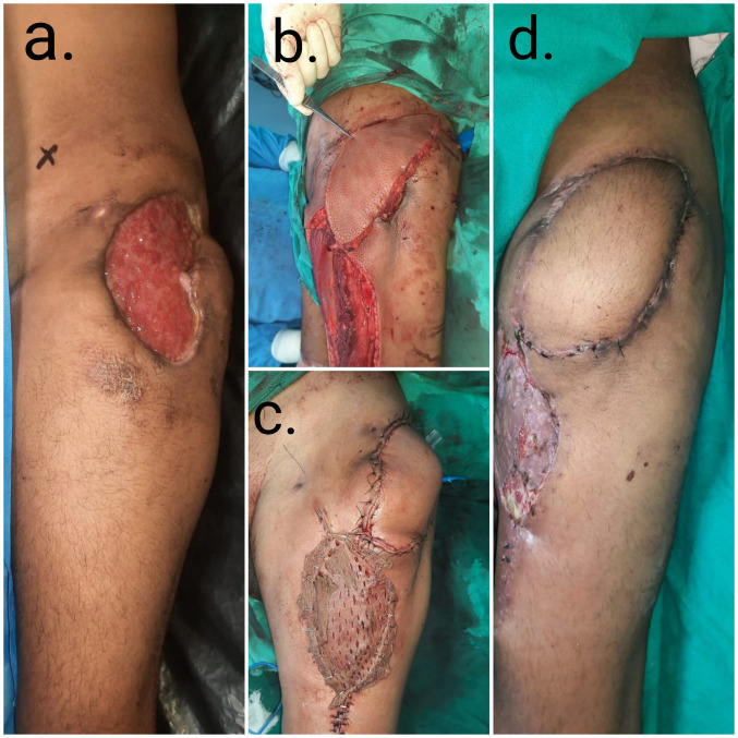 Pedicled anterolateral thigh flap: A versatile flap for complex regional defect reconstruction.