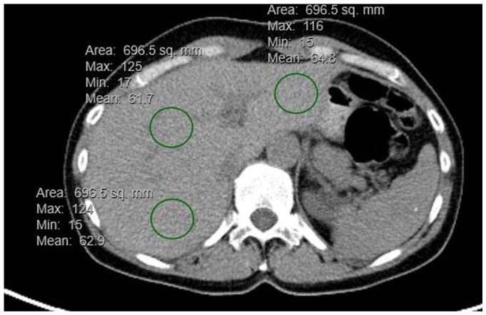 Frequency of Hepatic Metastatic Disease in Patients with Stage IV Breast Cancer Is Similar for Steatotic and Non-Steatotic Livers.