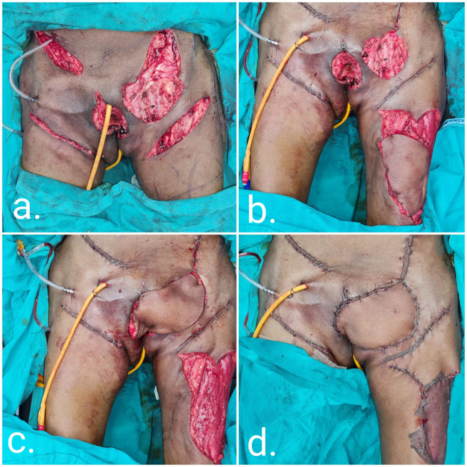 Pedicled anterolateral thigh flap: A versatile flap for complex regional defect reconstruction.