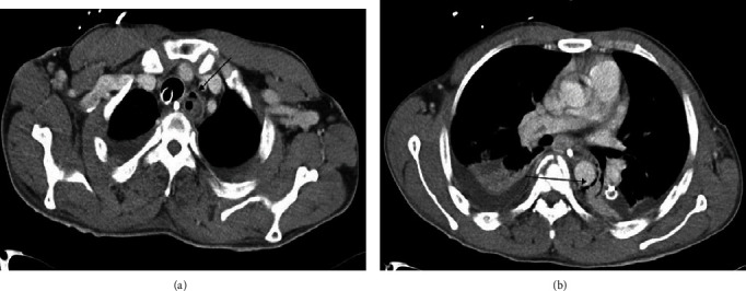 Occult Perforation of the Esophagus during Removal of an Enteral Feeding Tube: A Case Report and Literature Review.