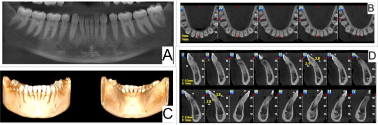 Intramucosal Melanocytic Nevi - A Rare Cause for Gingival Enlargement. Report of a Case and Review of Literature.