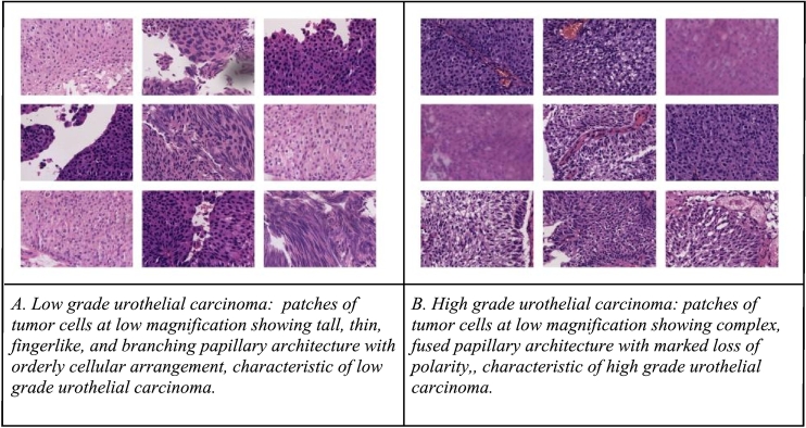 Differentiation of urothelial carcinoma in histopathology images using deep learning and visualization