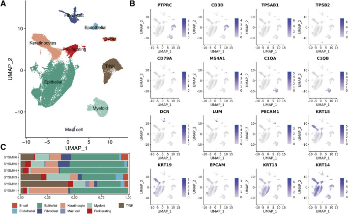 Single-cell transcriptome analysis reveals the clinical implications of myeloid-derived suppressor cells in head and neck squamous cell carcinoma.