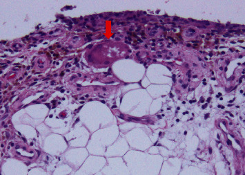 Persistent Hemarthrosis of the Knee after Arthroscopic Meniscal Repair.