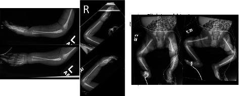 Novel TTN Mutation Causing Severe Congenital Myopathy and Uncertain Association with Infantile Hydrocephalus.