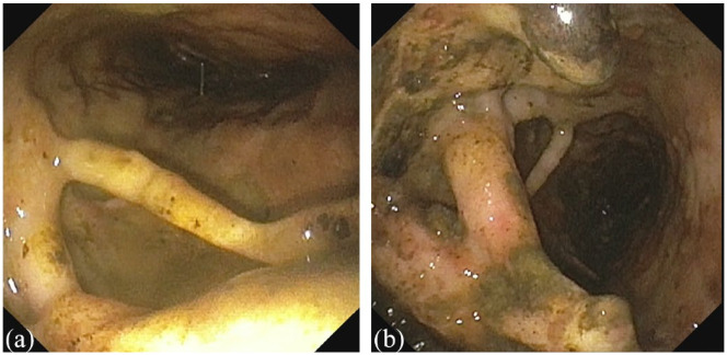 Endoscopic ultrasound drainage of pancreatic fluid collections: do we know enough about the best approach?