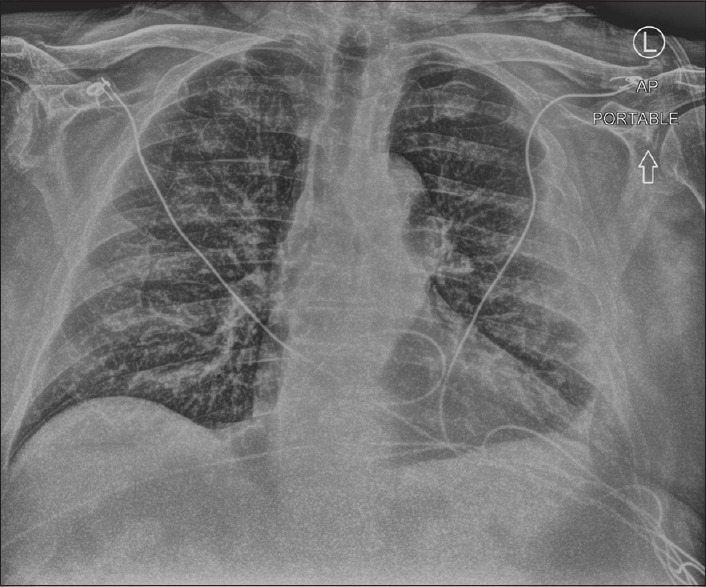 SARS-CoV-2 and Legionella Co-Infection.