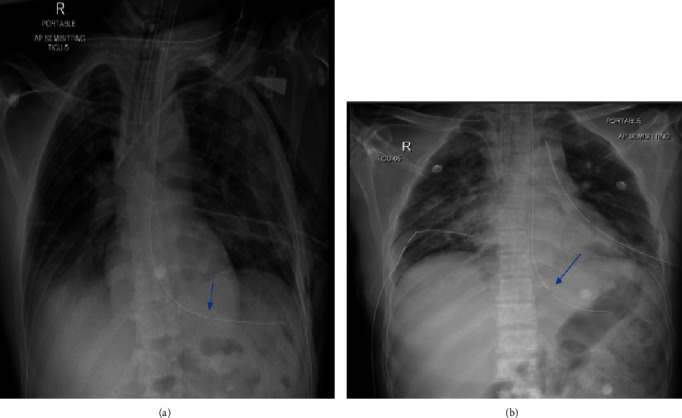 Occult Perforation of the Esophagus during Removal of an Enteral Feeding Tube: A Case Report and Literature Review.