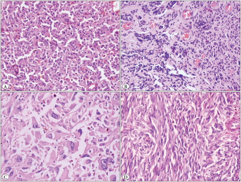 BRAF, NRAS, KIT, TERT, GNAQ/GNA11 Mutation Profile and Histomorphological Analysis of Anorectal Melanomas: A Clinicopathologic Study.