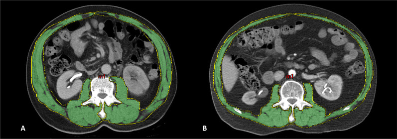 Sarcopenia is an independent predictor of survival in patients undergoing radical cystectomy for bladder cancer: a single-centre, retrospective study.