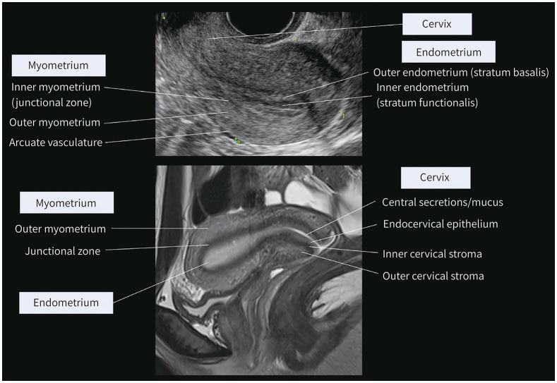 [Radiologic Evaluation of Uterine Lesions Using a Pattern Recognition Approach].