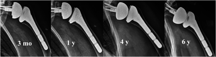 Reverse Shoulder Arthroplasty for Patients with Massive Rotator Cuff Tears or Cuff Tear Arthropathies at a Minimum Follow-up of 7 Years.