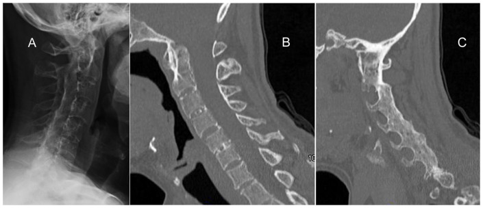 Spondyloarthropathies That Mimic Ankylosing Spondylitis: A Narrative Review.