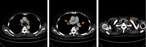 Lymphocyte-Rich Hepatocellular Carcinoma with Multiple Lymphadenopathy and Positive Epstein-Barr Virus Encoding Region.