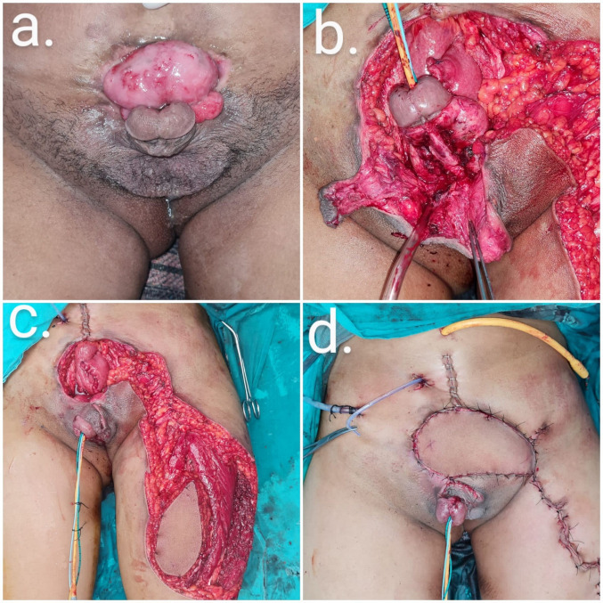 Pedicled anterolateral thigh flap: A versatile flap for complex regional defect reconstruction.