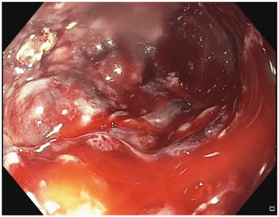 Endoscopic ultrasound drainage of pancreatic fluid collections: do we know enough about the best approach?