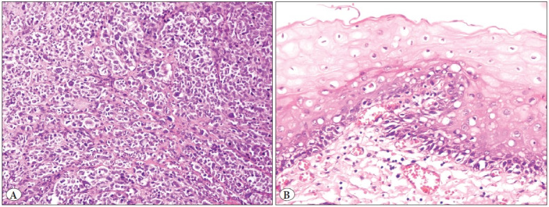 BRAF, NRAS, KIT, TERT, GNAQ/GNA11 Mutation Profile and Histomorphological Analysis of Anorectal Melanomas: A Clinicopathologic Study.