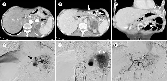 Isolated Gastric Varix Bleeding Caused by Splenic Vein Obstruction: Two Case Reports.