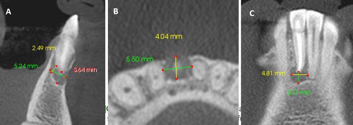 Tomographic, microbiological and histological characterization of secondary apical periodontitis: case series.