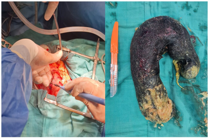 Trichobezoar: A Rare Cause of Gastric Obstruction.